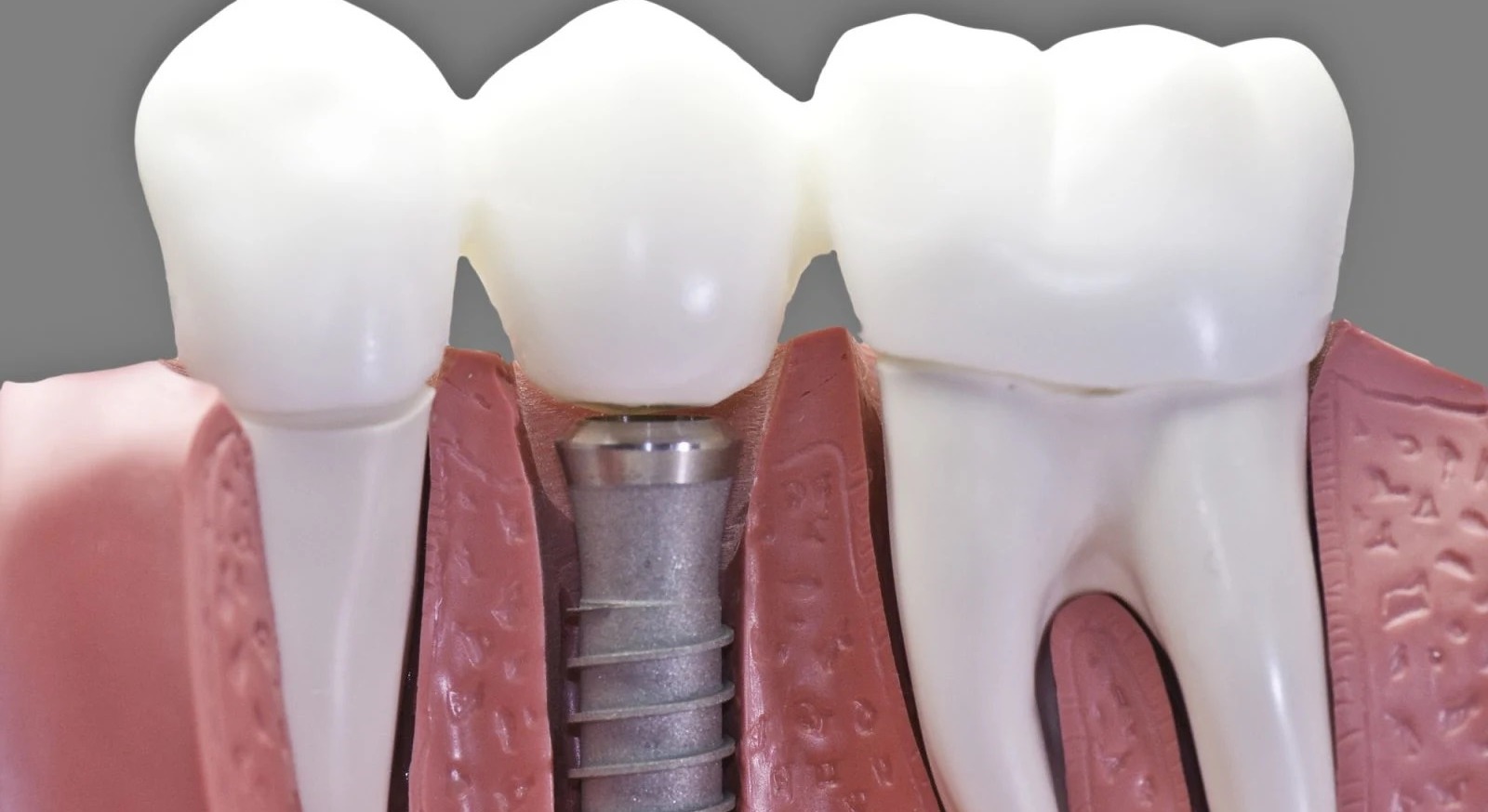 DU de parodontologie et implantologie clinique